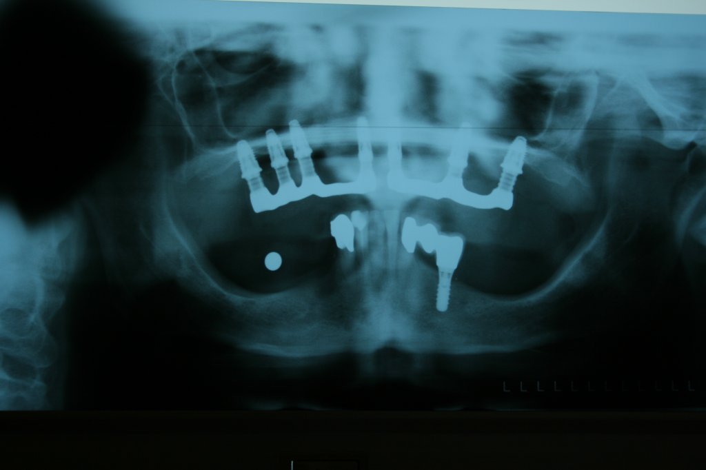 image-7837917-Leistungen-Implantologie-Nobel_Gide_Implantatversorgung_Oberkiefer_komplett.w640.jpg